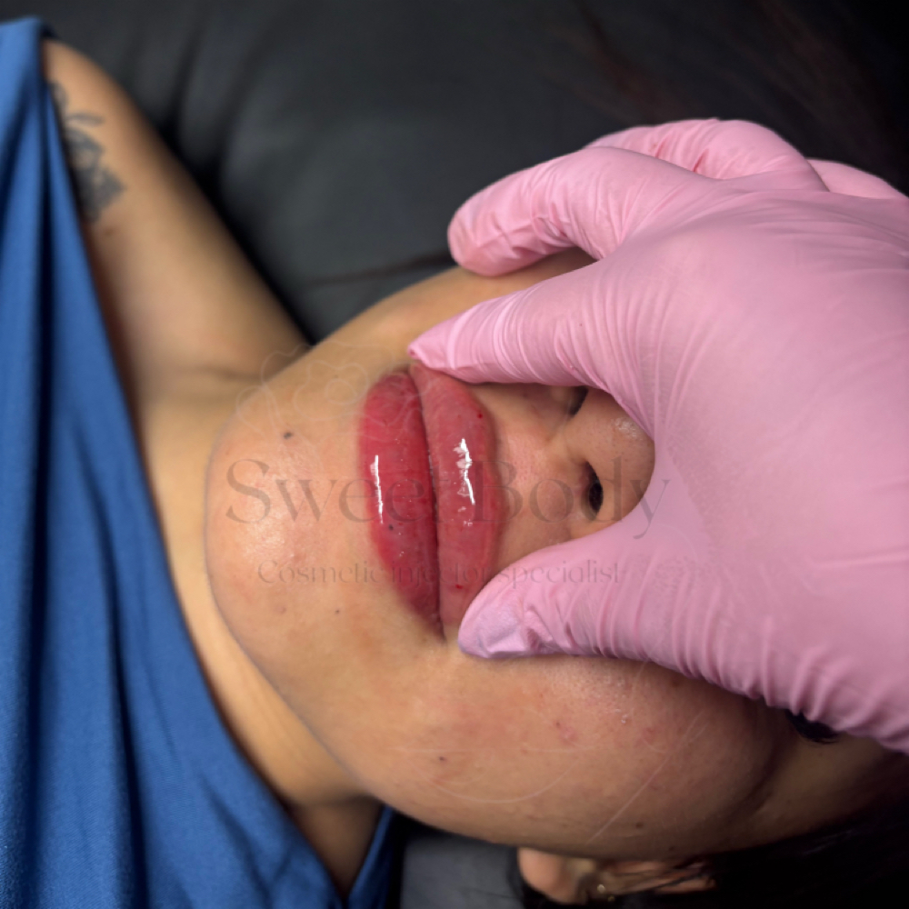 Lip Filler 1ML Promotion (SA) at SWEET BODY in San Antonio, TX