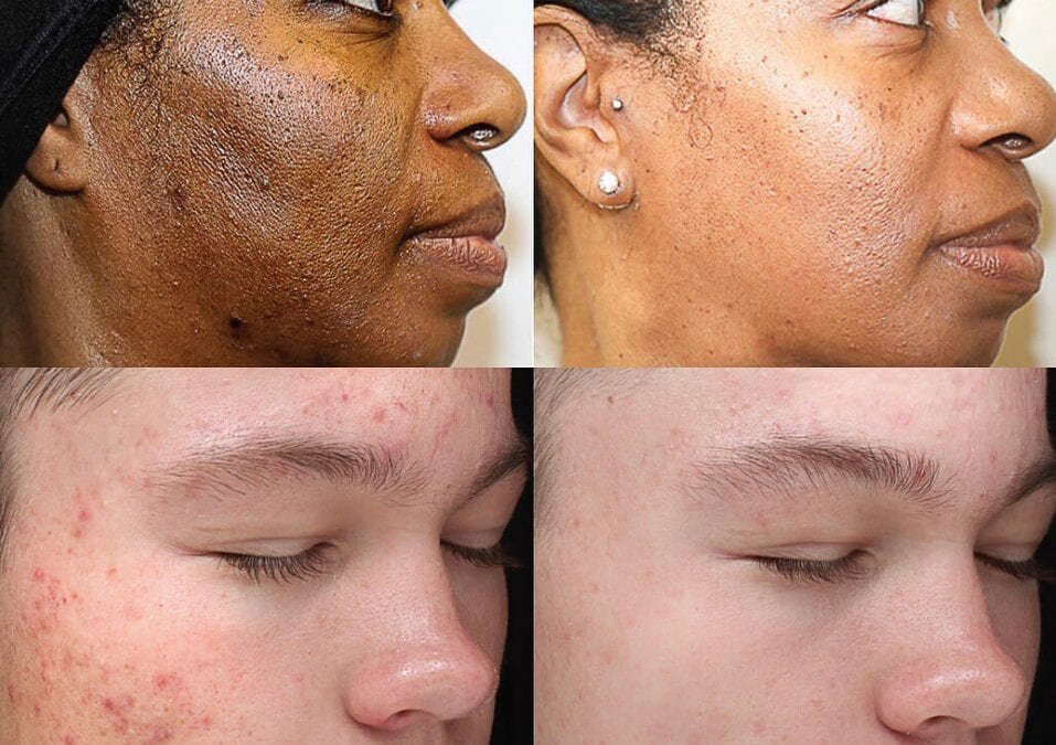 Corrective Chemical Peel