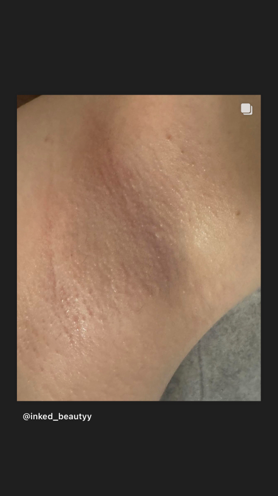 Underarms