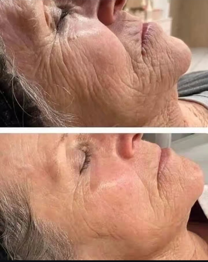 Procell Microchanneling Facial