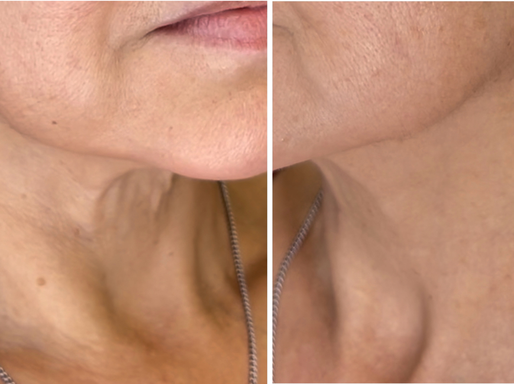 Face Skin Tightening