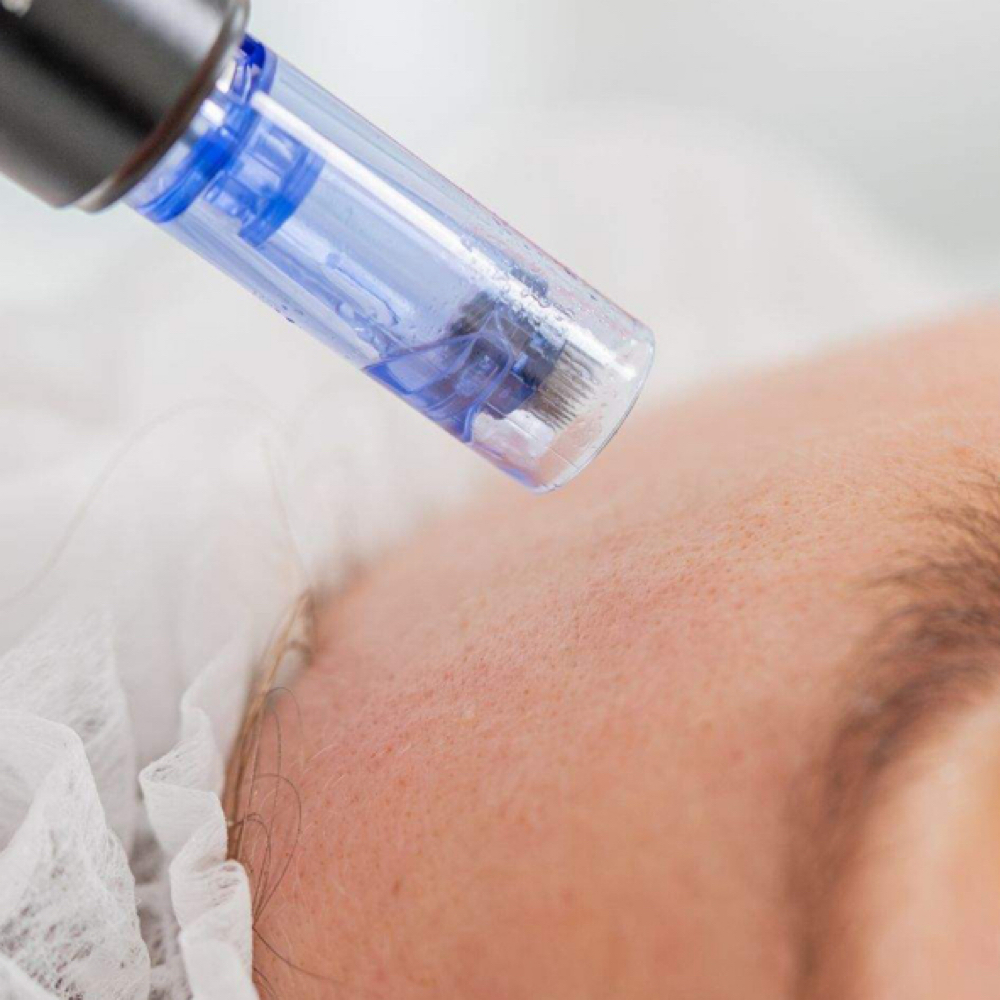 Microneedling at Babe on E Esthetics in Sanford, NC