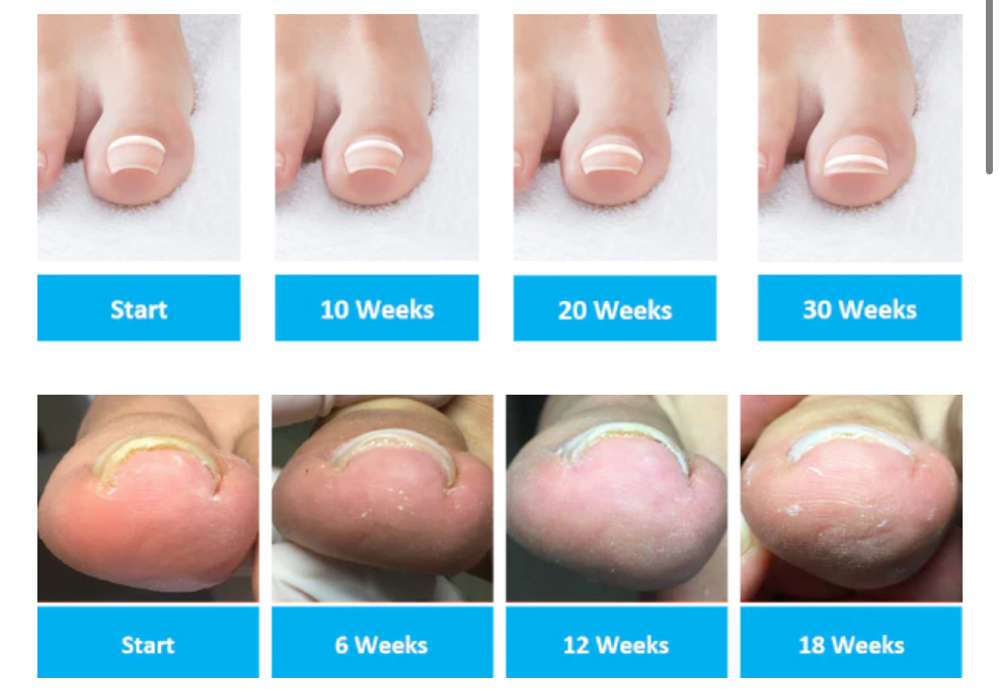 ONYFIX Nail Correction