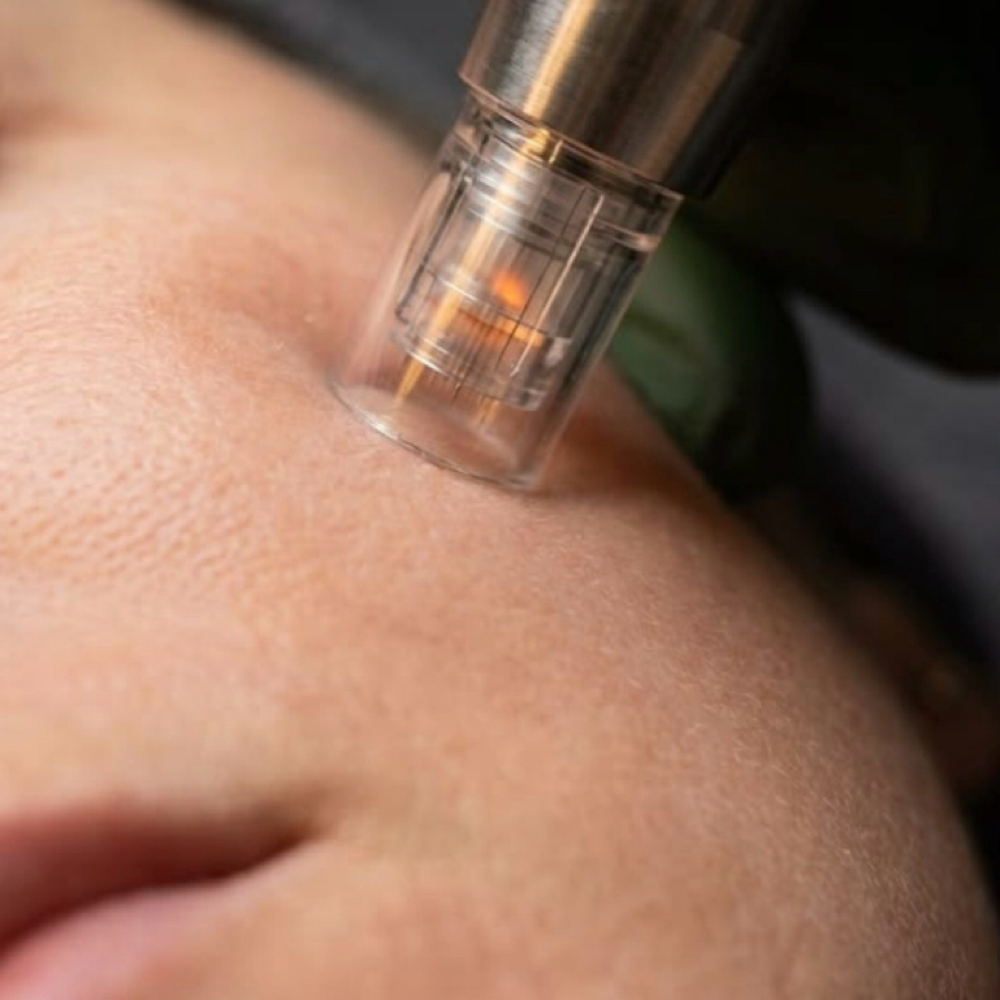 Nano Infusion at Graceful Esthetics in Flower Mound, TX