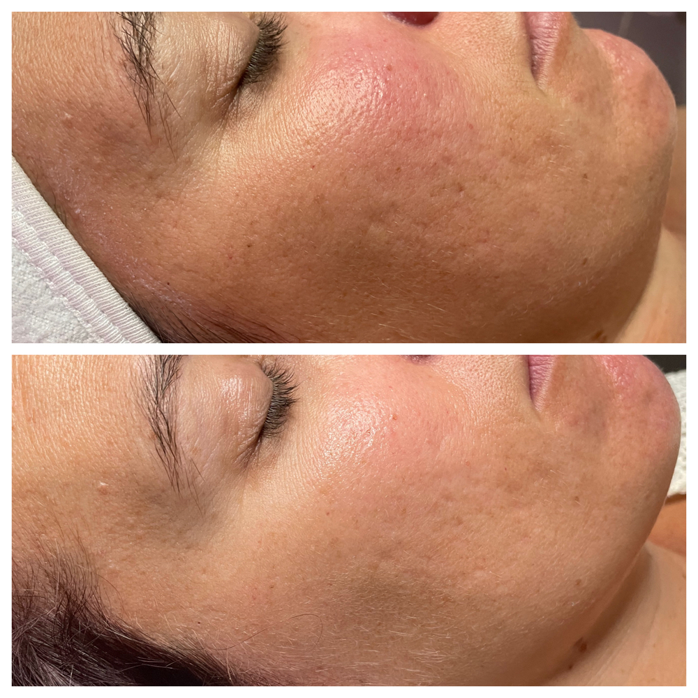 Treatment Facial