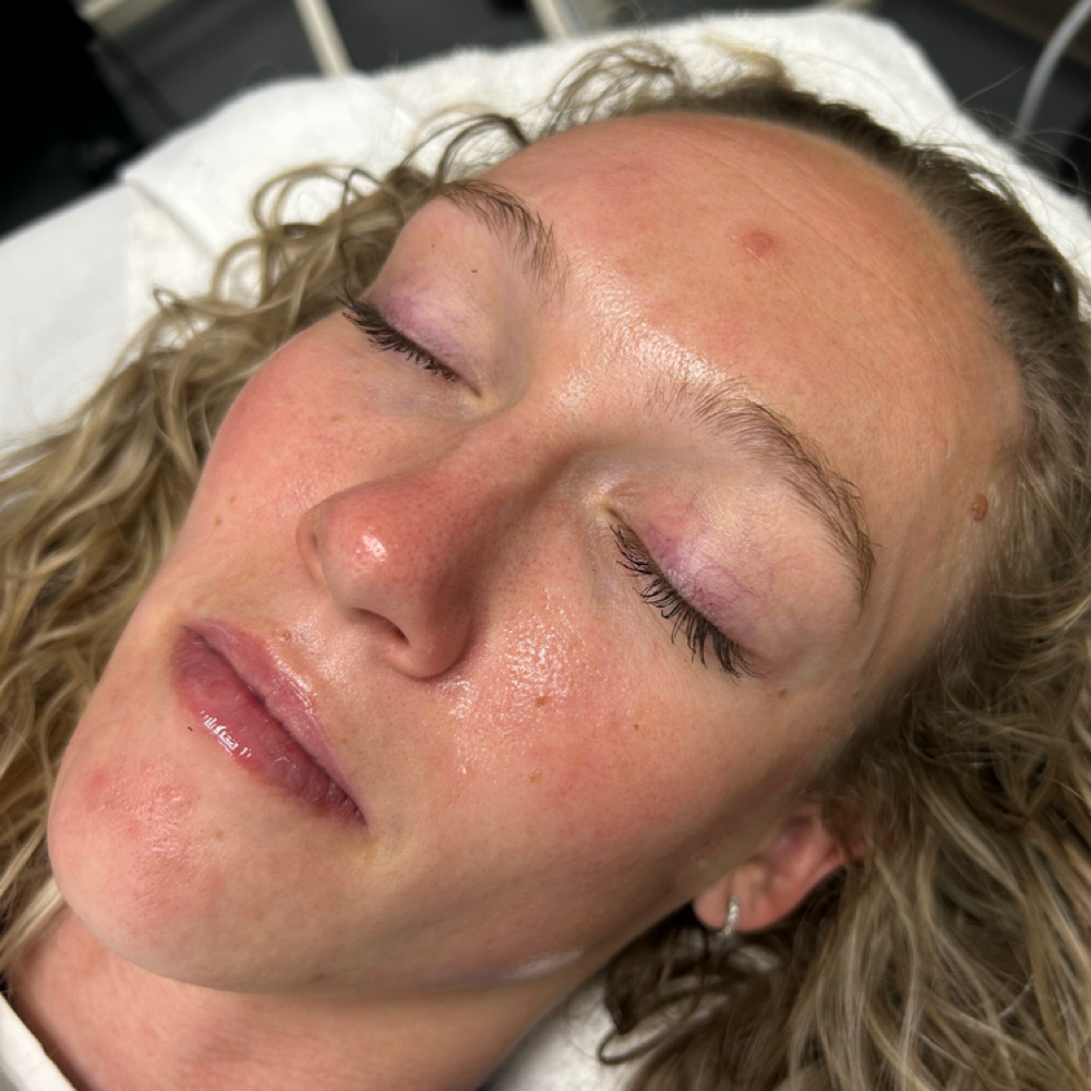 The Dermaplane Facial at GET ESTHETIC BY GEM in Simi Valley, CA