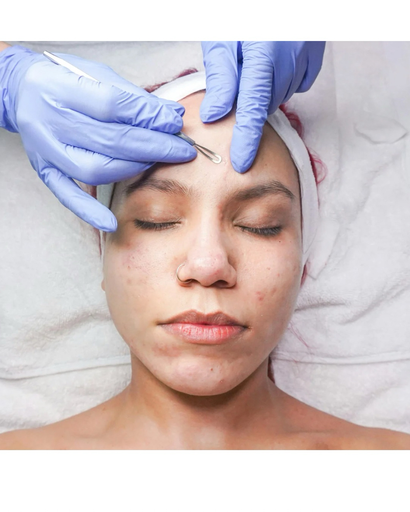 Acne Returning Clients