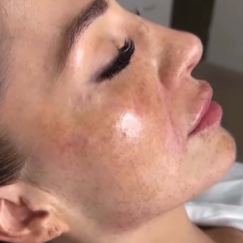 Filler Jawline at Gold Stone Beauty in mcallen, TX