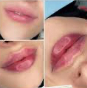 Needless Lip Filler 1.5 ML at Ash N Aura in Crofton, MD