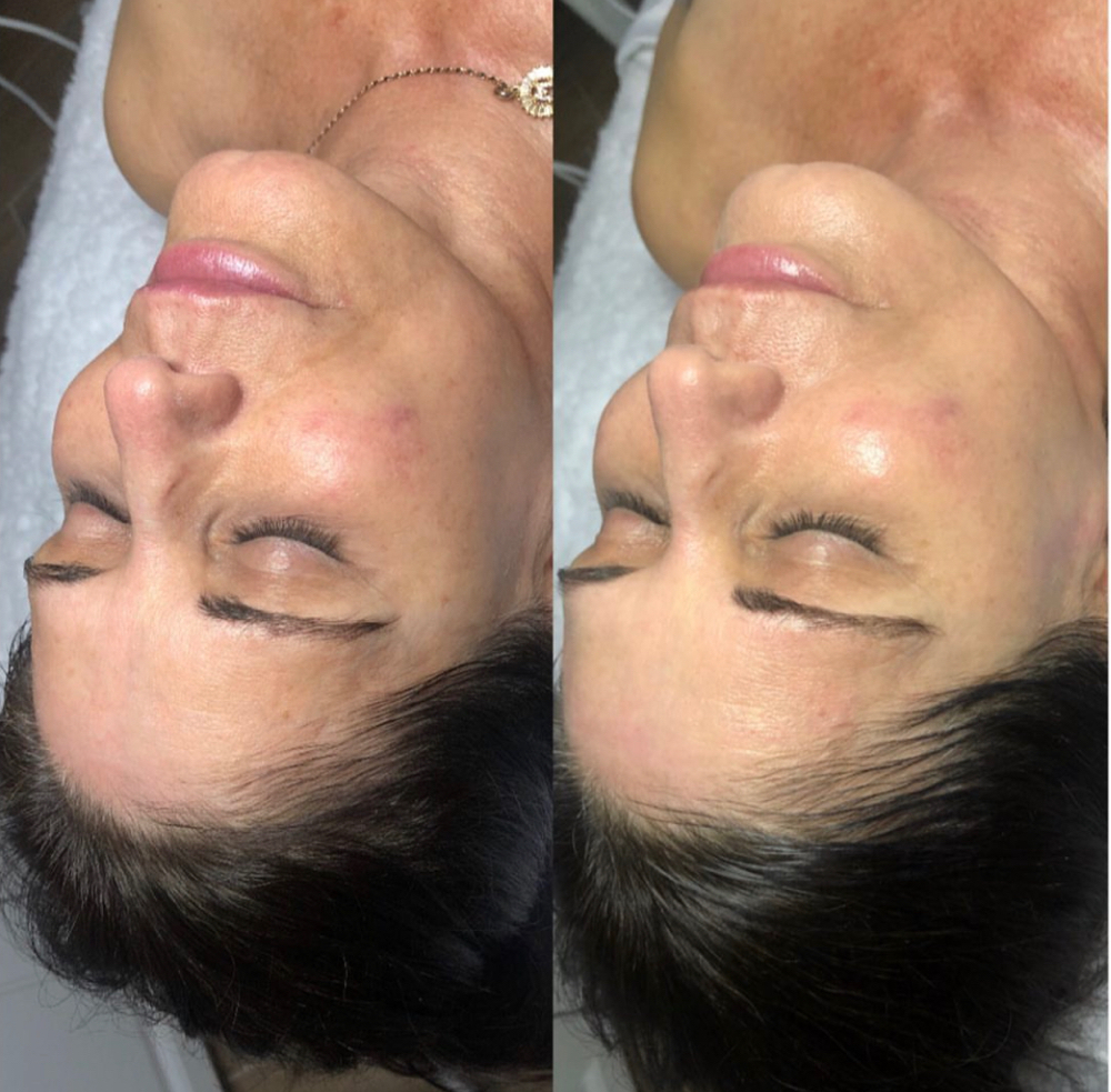 Chemical Peel