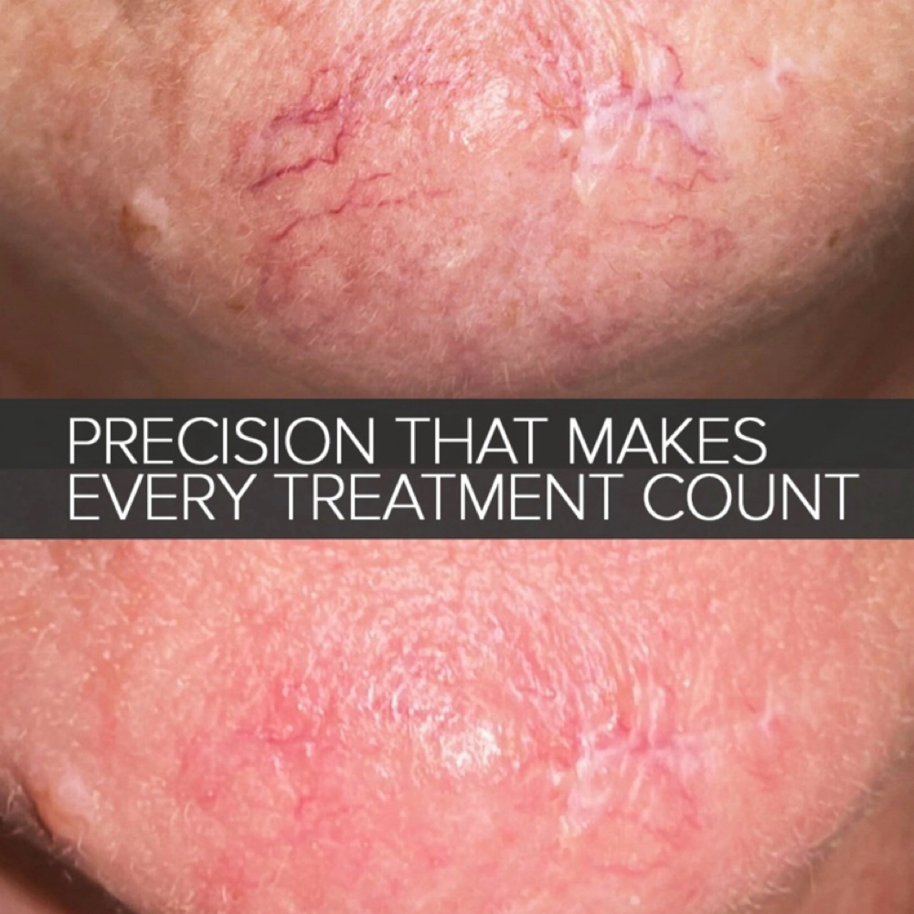 Thermoclear at Vox SKIN in Litchfieldpark, AZ