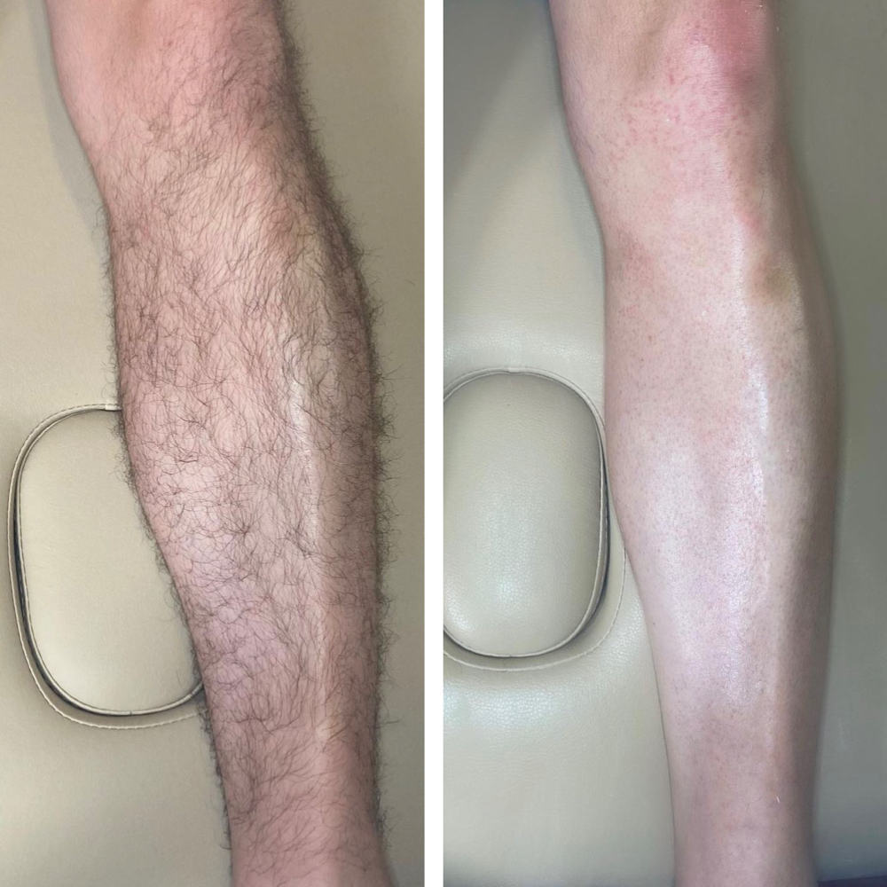 Full Leg