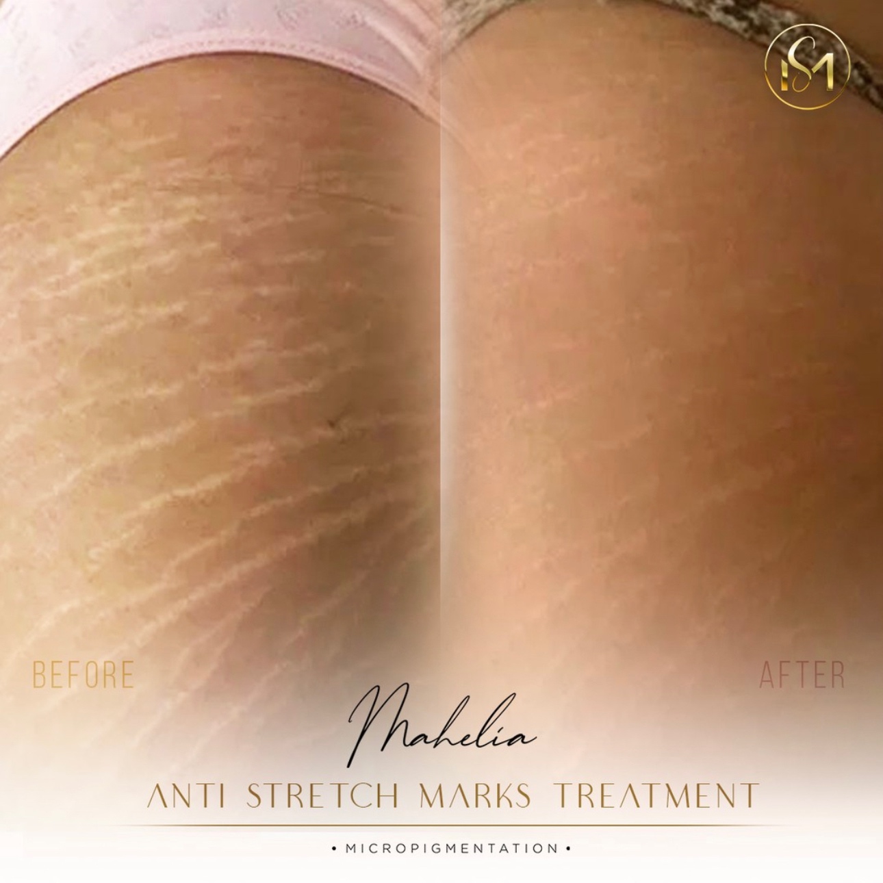 STRETCH MARKS at Mahelia PMU Academy in Whittier., CA