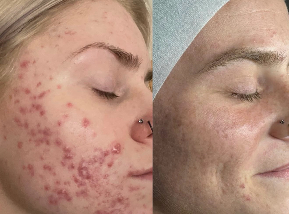Acne Peel 2