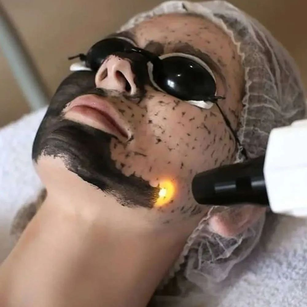 🌱Carbon Laser Peel