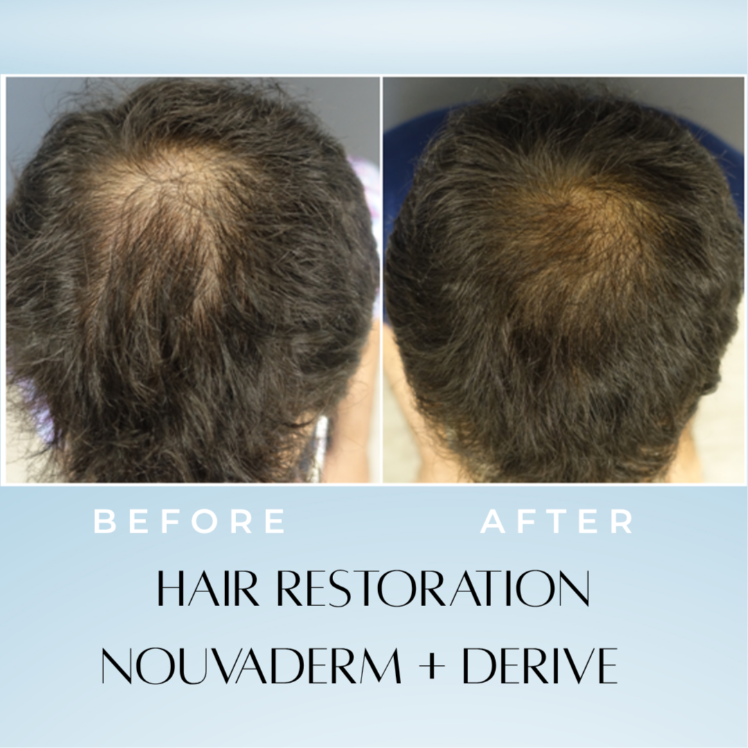 Hair Restoration at White Lotus Medical Spa in Scottsdale, AZ