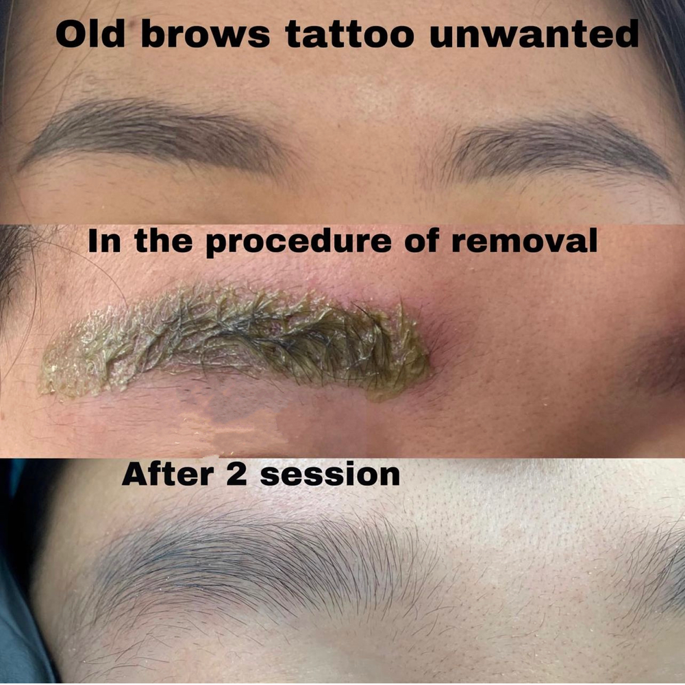 Tattoo Removal Treatment