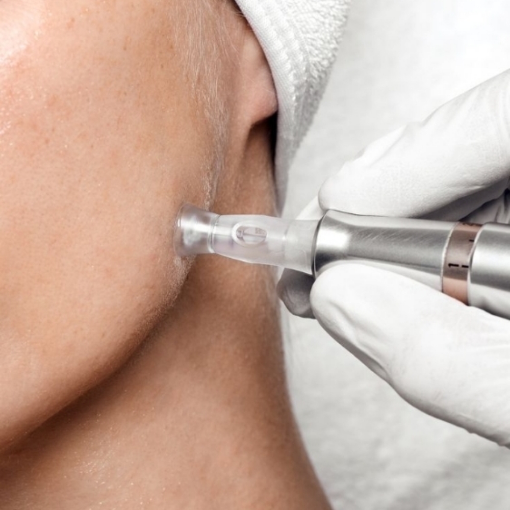 Nano Corrective Peel at Xiomara Studio in Dallas, TX