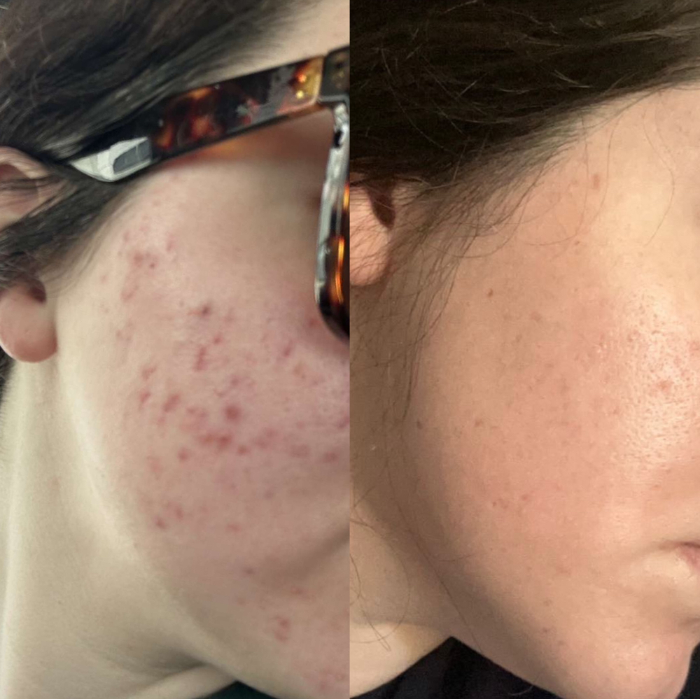 Face Reality Acne Peel