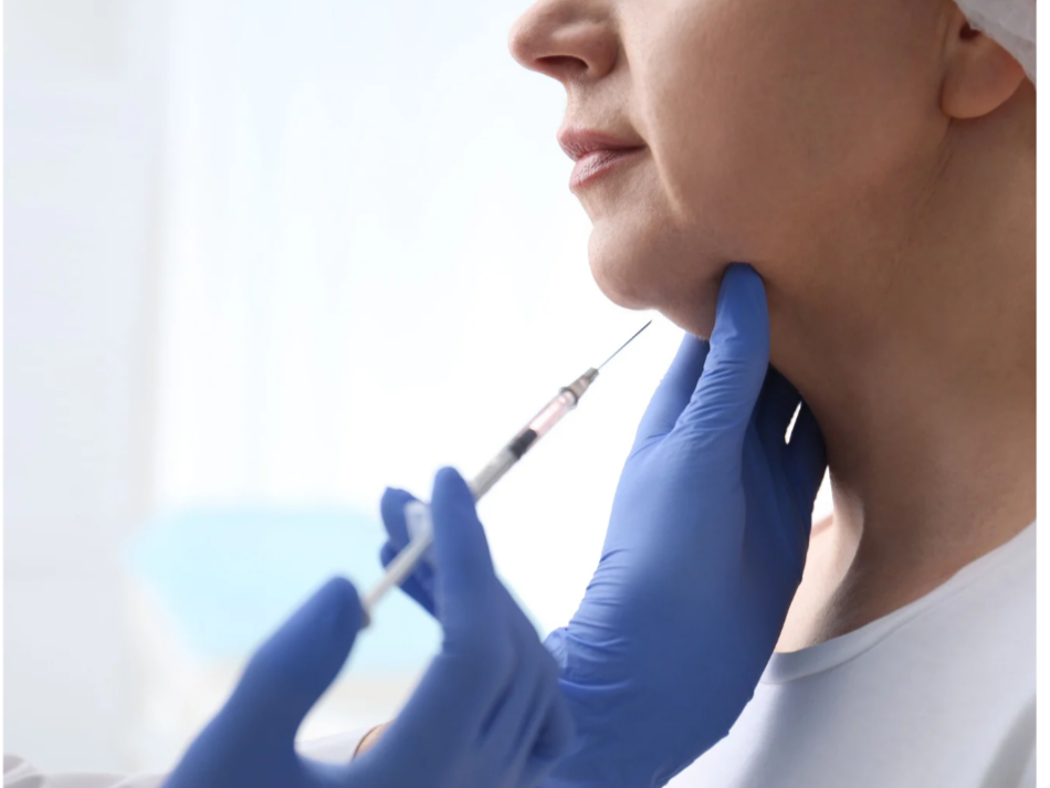 Kybella Injections