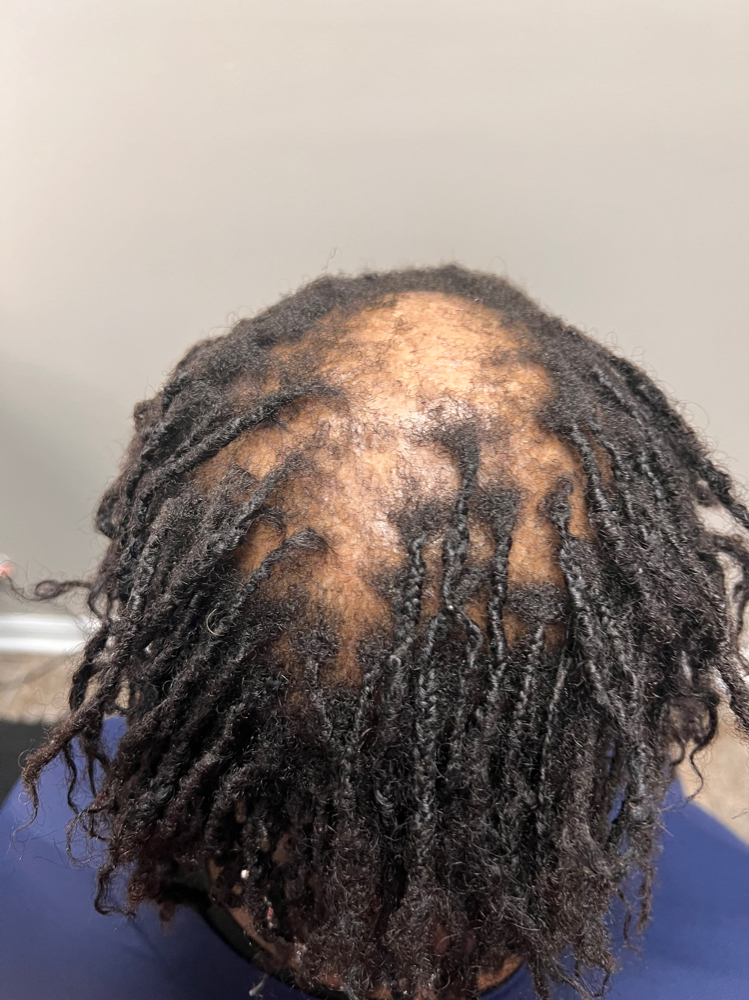 Alopecia W/ Triscope Consultation