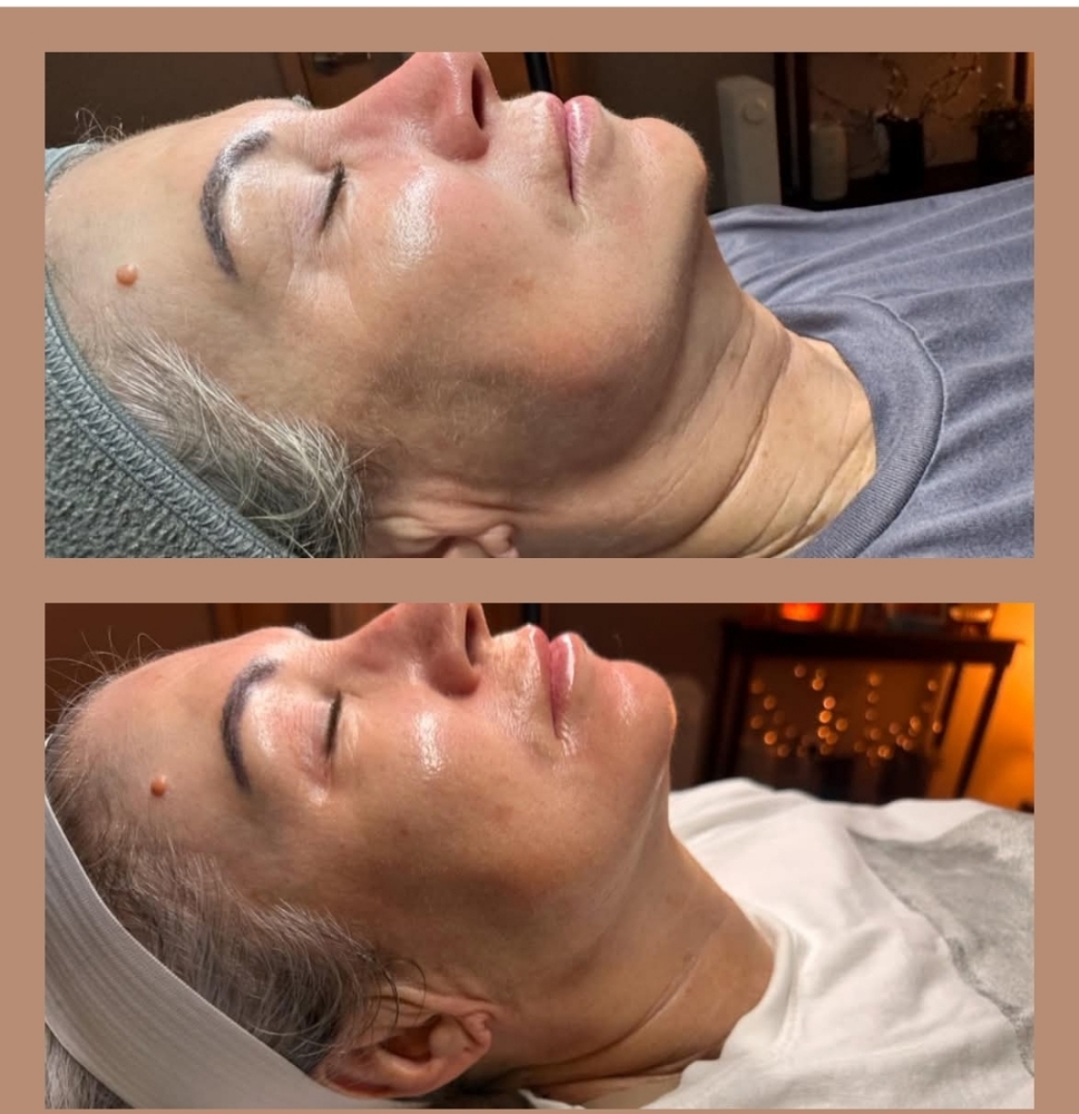 Procell Microchanneling therapy
