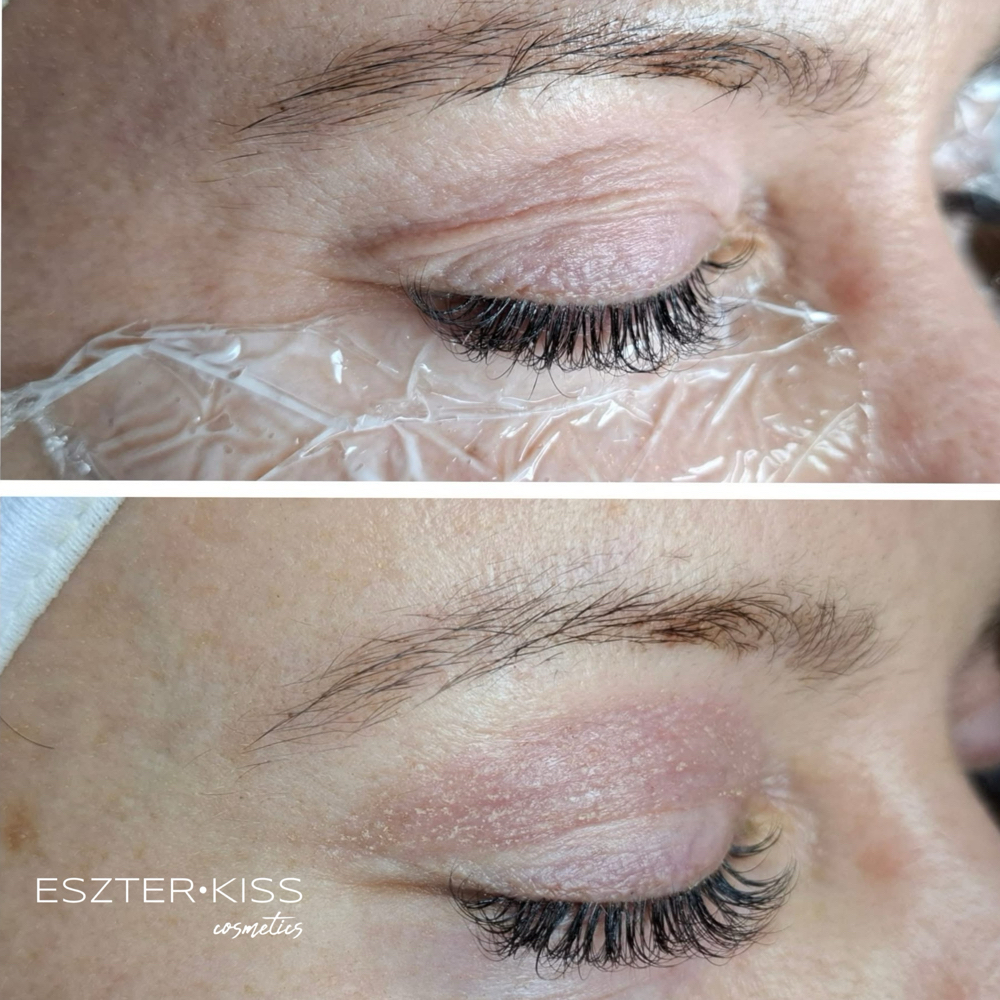 Upper Eyelid - Plasma Fusion at Eszter Kiss Cosmetics in Deltona, FL