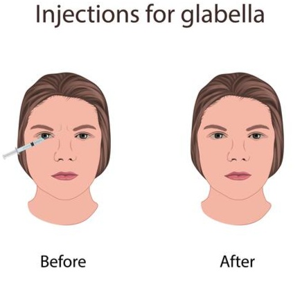 12-20 Units of Xeomin