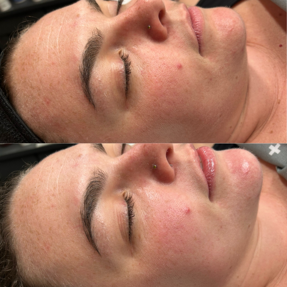 LuxeLift Sculpting Facial at Lil’ Devil Esthetics in Reno, NV