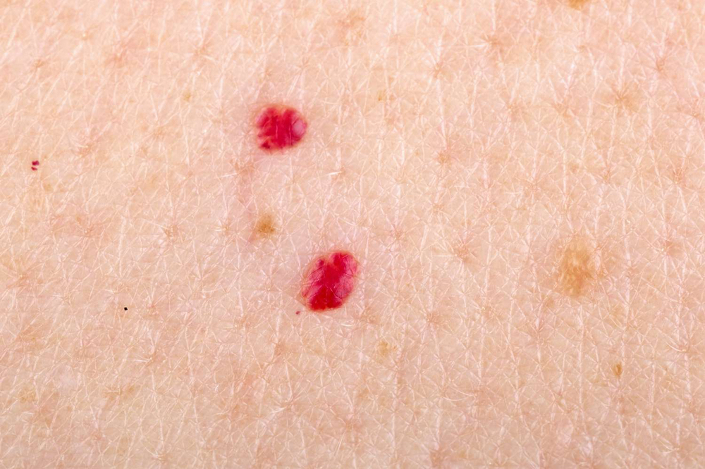 Cherry Angioma Removal