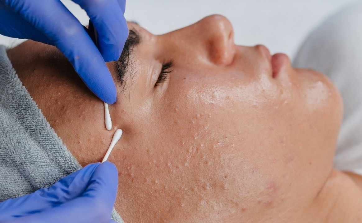 ACNE RELIEF & EXTRACTION