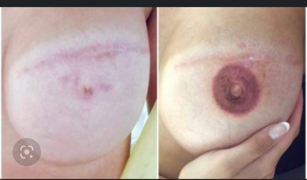 3D Areola at Ideal Ink Lab in Miami, FL