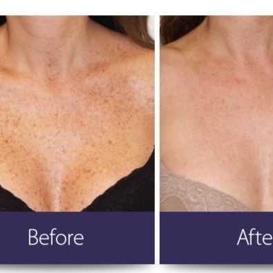 IPL face, neck and chest at The Laser Collective in Gilbert, AZ