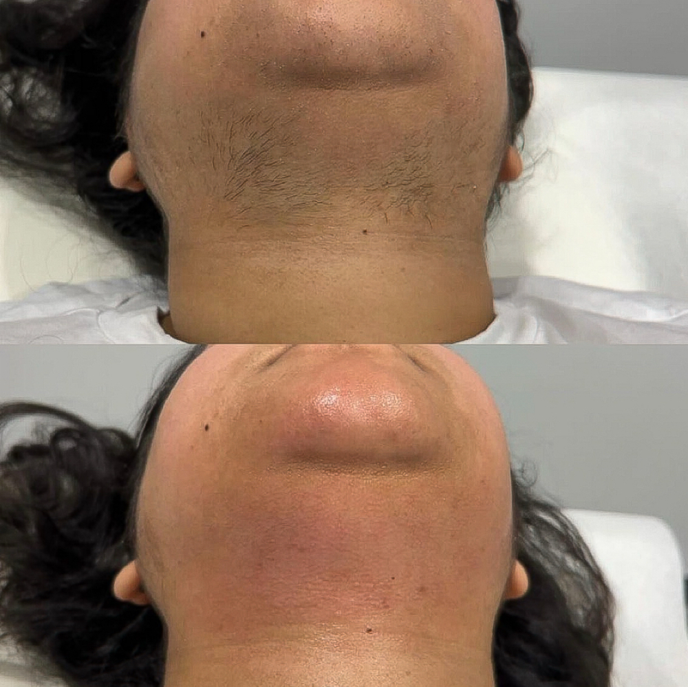 Chin Sugaring at Gegee's Spa on Devine in Columbia, SC