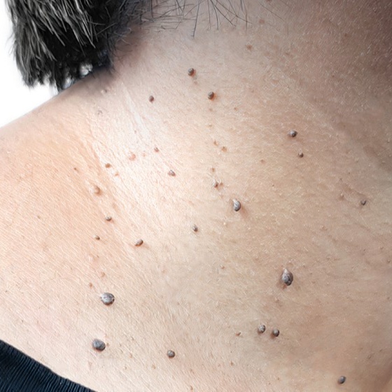 Skin Tags Removal 1hr at Haus of Glam by Karina J in Haverhill, FL