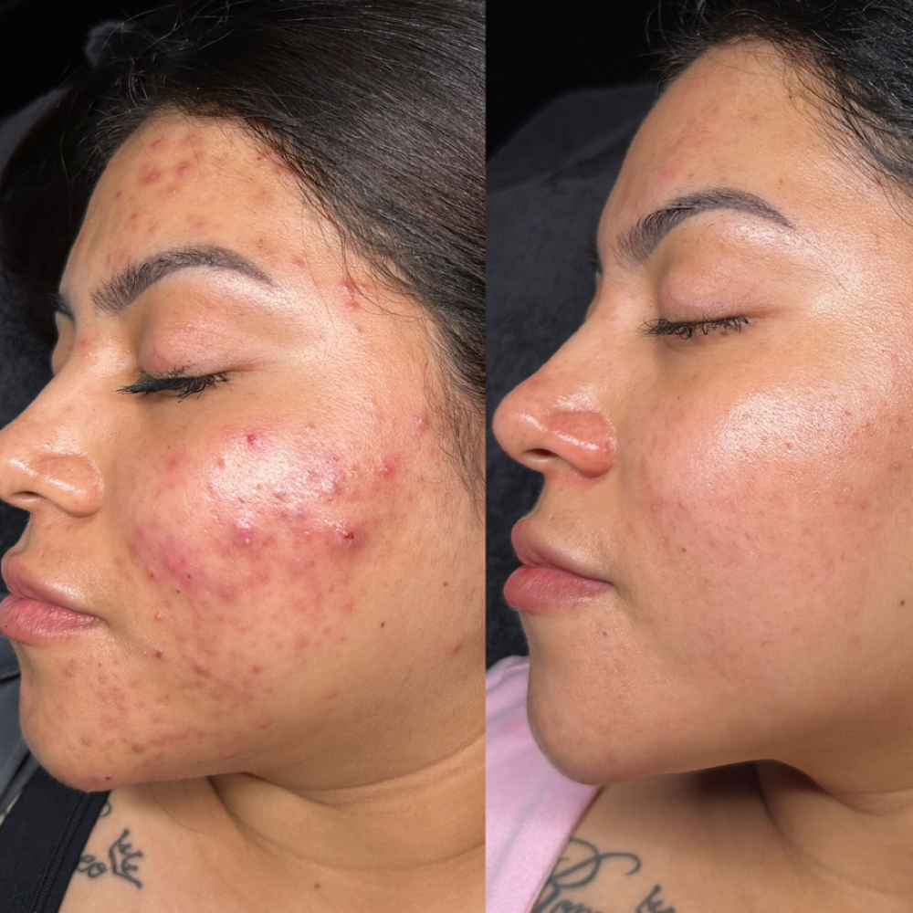 Virtual acne boot camp check in at Esthetics By Luci in New Albany, IN