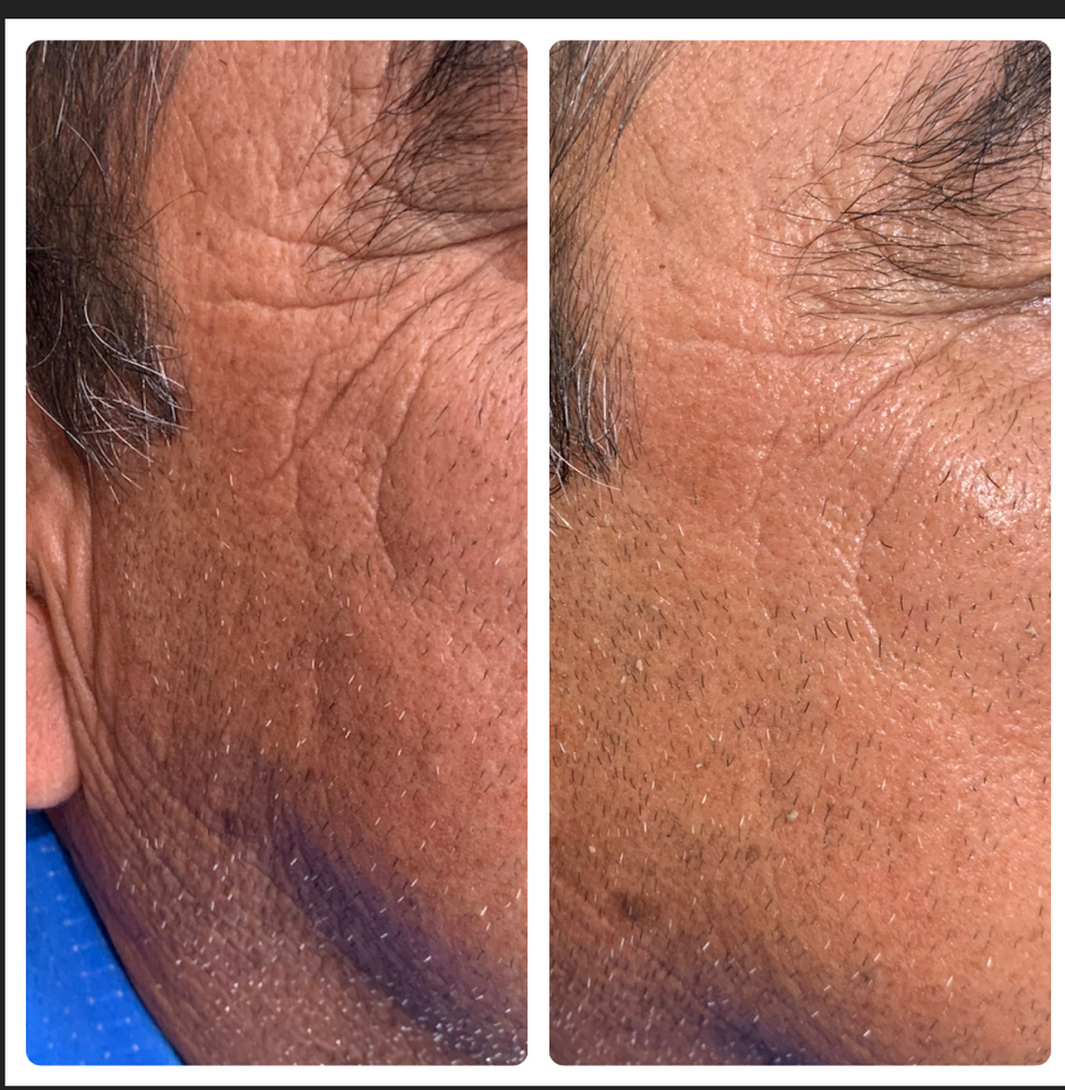 Radiofrequency Facial