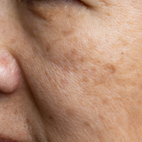 Sun Damage or Age Spot Appt Hold