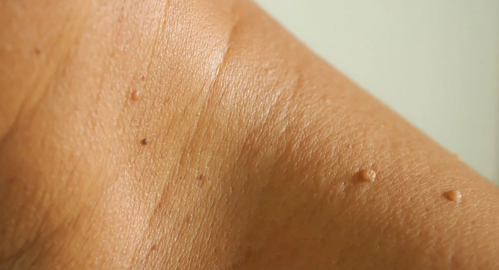 Skin Tag Removal