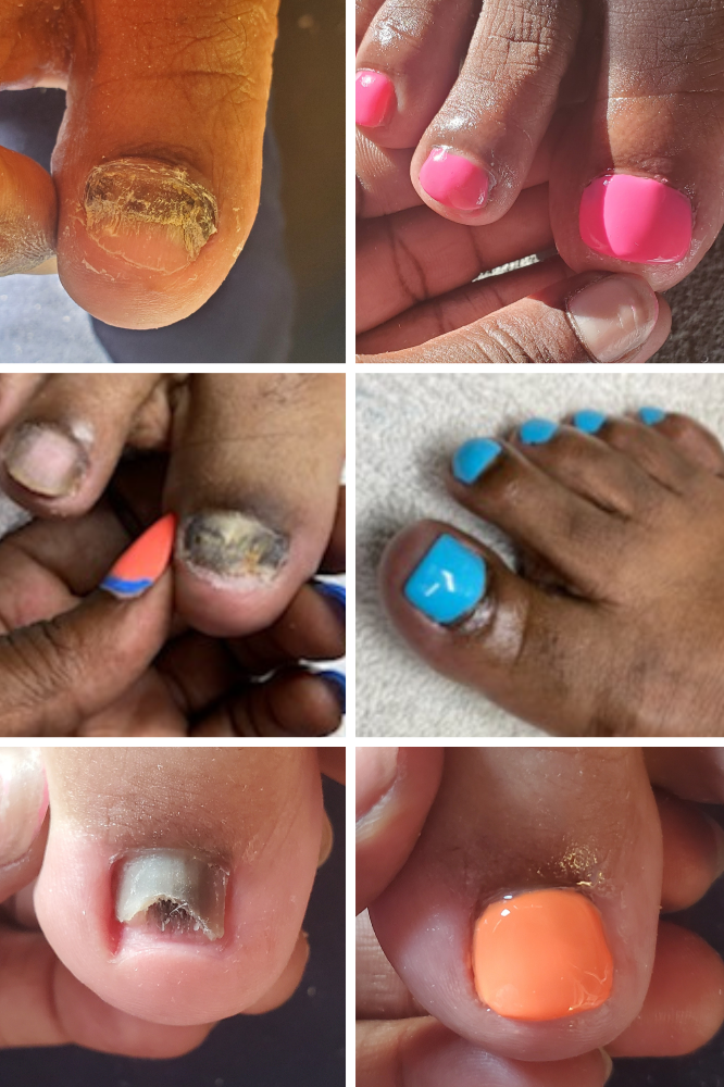 Prosthetic Nail Reconstruction