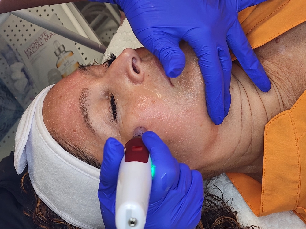 Microneedling