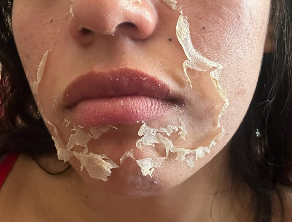 Chemical Peel