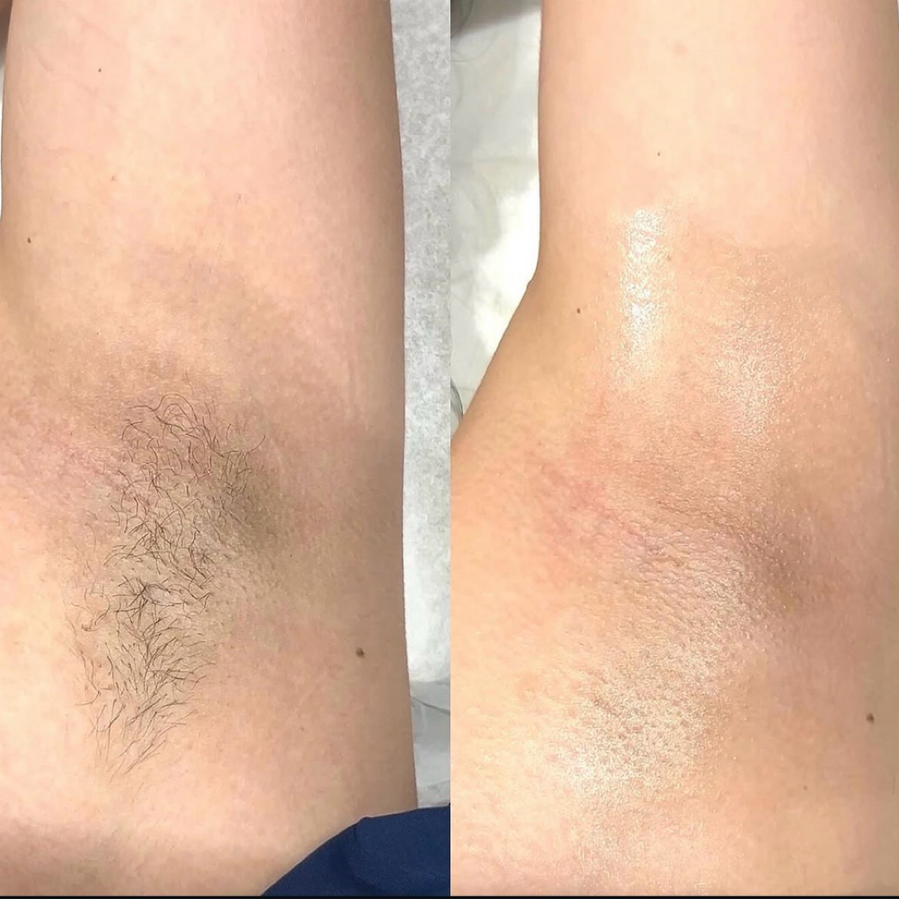 Underarm Wax at Blissful Beauty Esthetics in Lufkin, TX