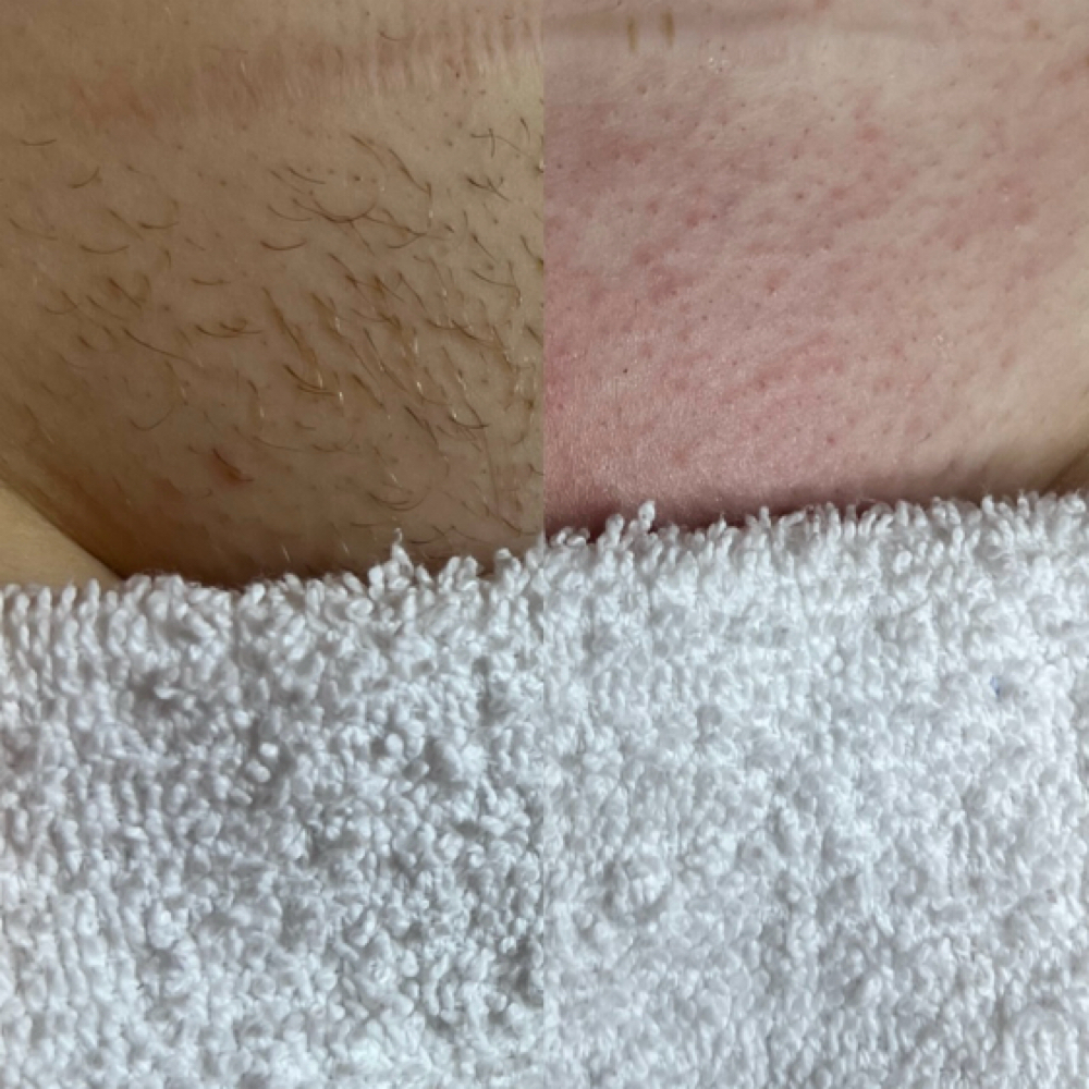 Brazilian Wax(V) at Esthetics By Haleigh in Kinston, NC