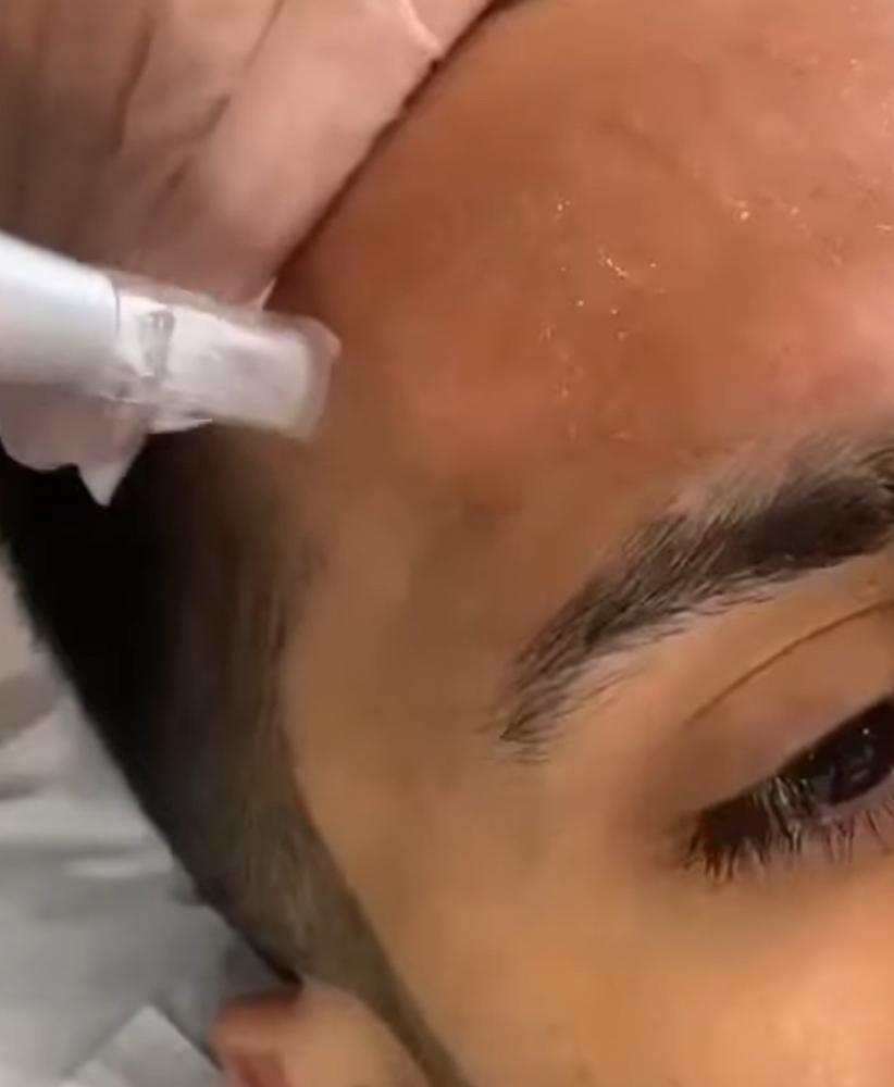 Hydra-Microneedling at Signature Skin Spa in Scottsdale, AZ