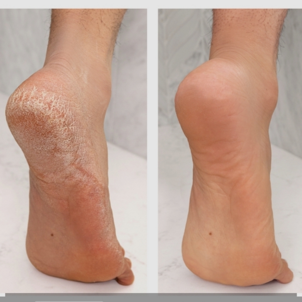 Calluses Removal Pedicures at Chicago's Favorite Nail Spa in Lansing, IL