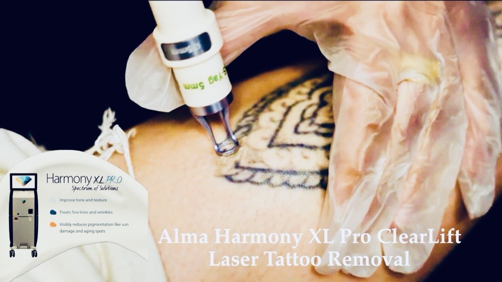 Tattoo Removal Q-Switched Nd:YAG 10