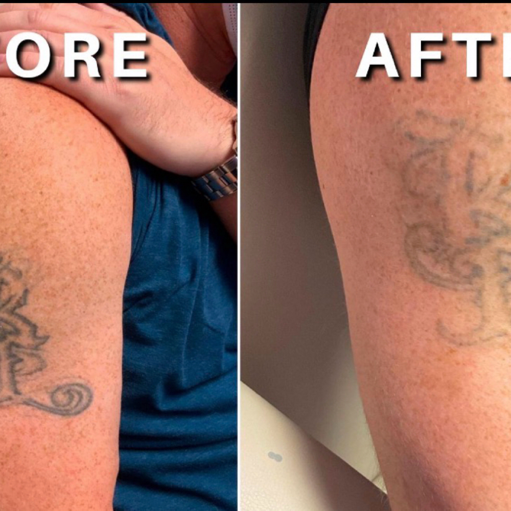 Tattoo Removal (6) at La Belle Studio by Soraya in Woburn, MA