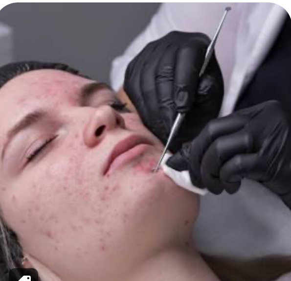 Acne Facial / Tratamiento de Acne