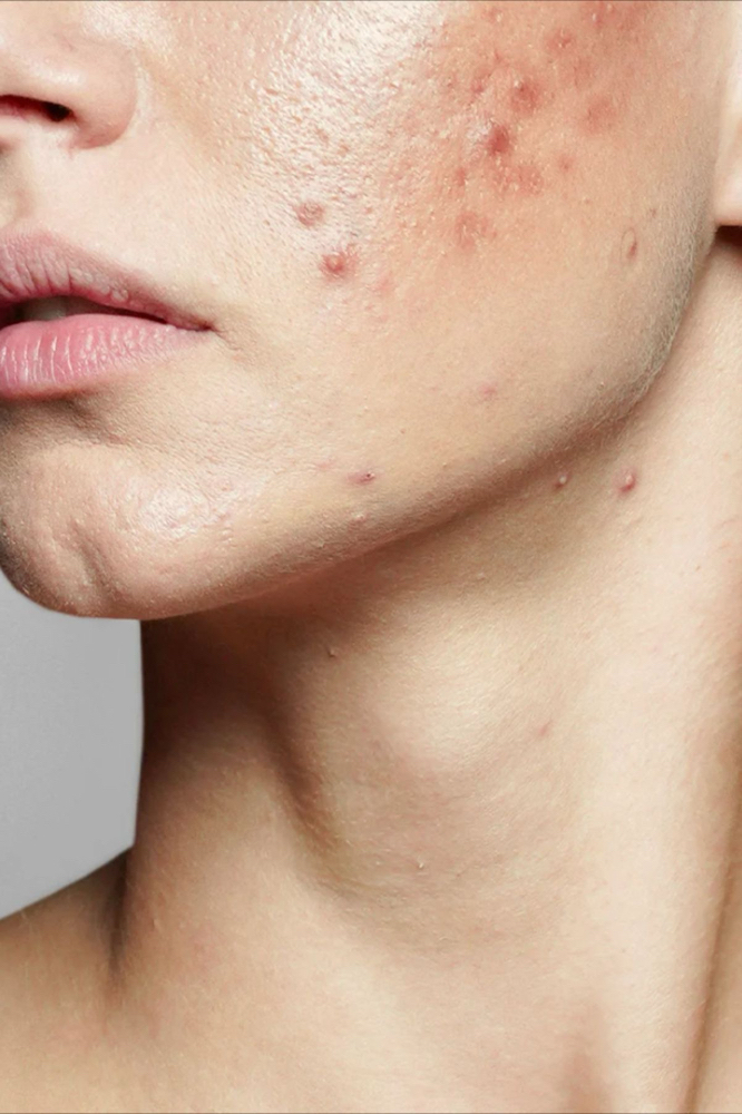 The Acne Reset